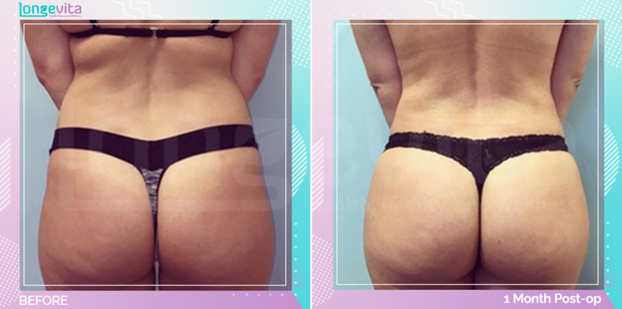 Bum Lift and Liposuction before and after, Body