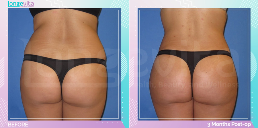 Bum Lift and Liposuction before and after, Body