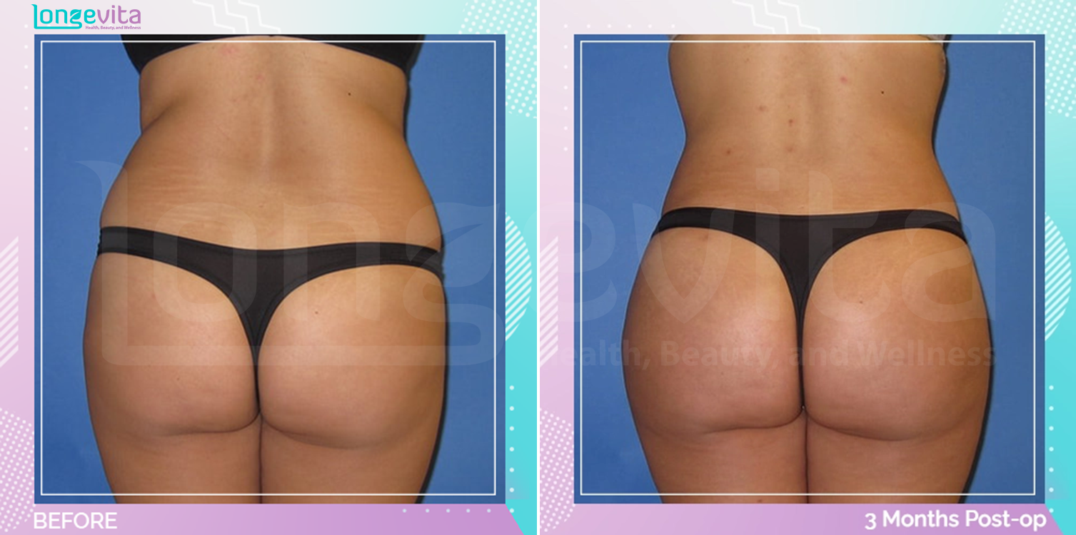 Bum Lift and Liposuction before and after, Body