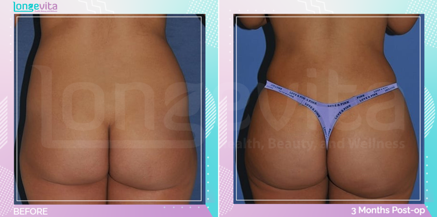 Bum Lift and Liposuction before and after, Body