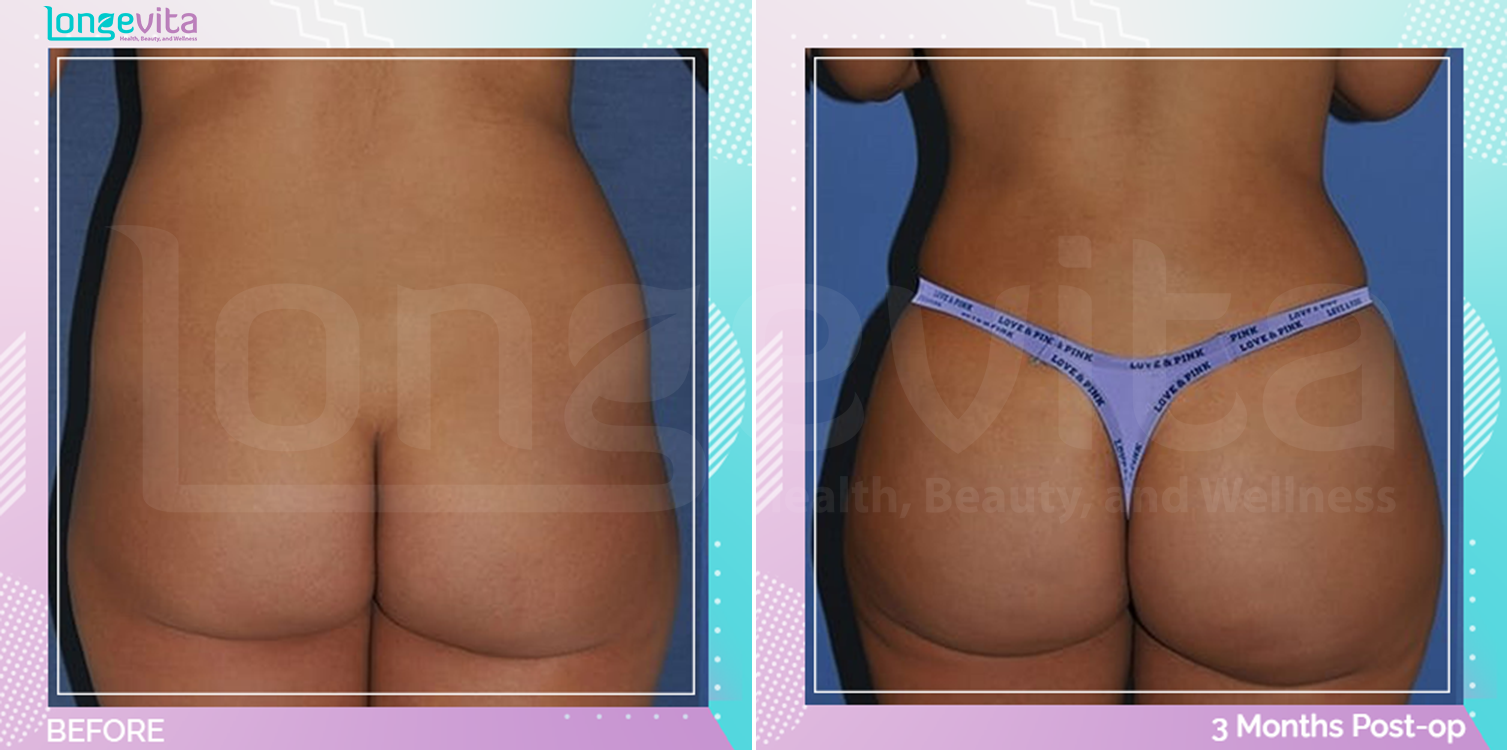 Bum Lift and Liposuction before and after, Body