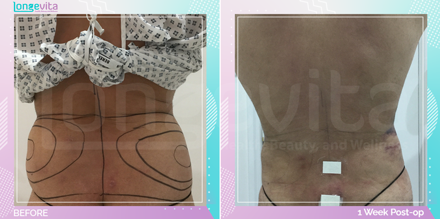 Liposuction before and after, Body
