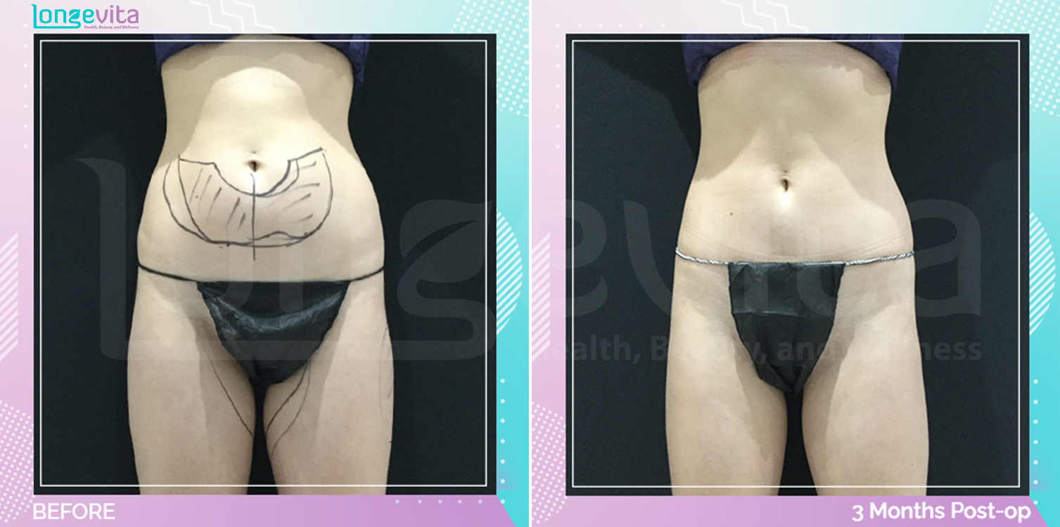 Liposuction before and after, Body