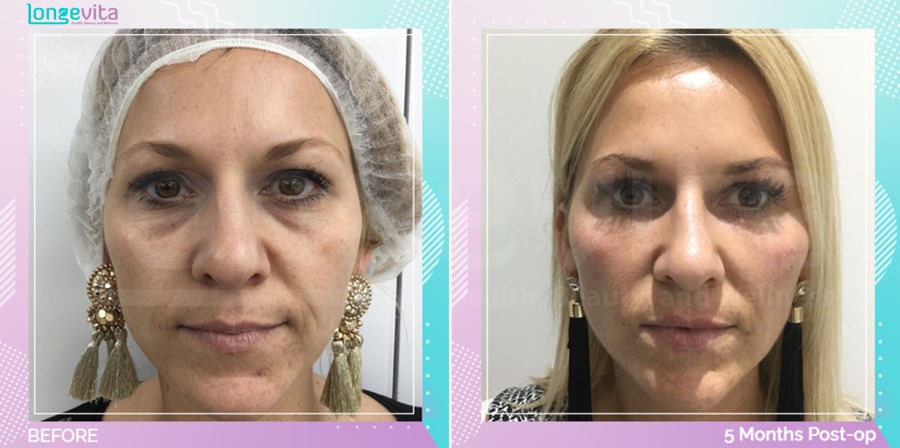 Eyelid and Mid Facelift before and after, Face