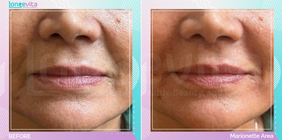 Dermal Fillers before and after, Face