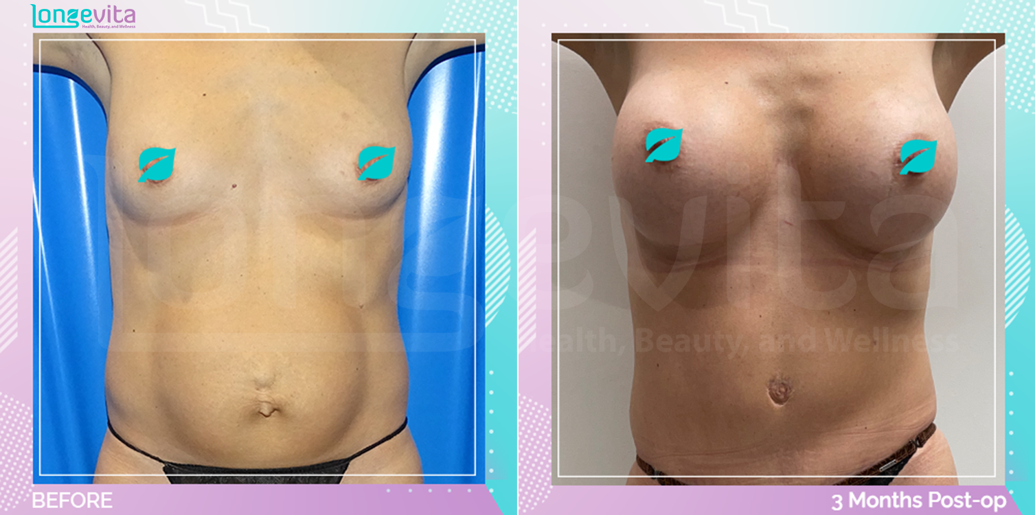 Breast Enlargement and Tummy Tuck before and after, Body