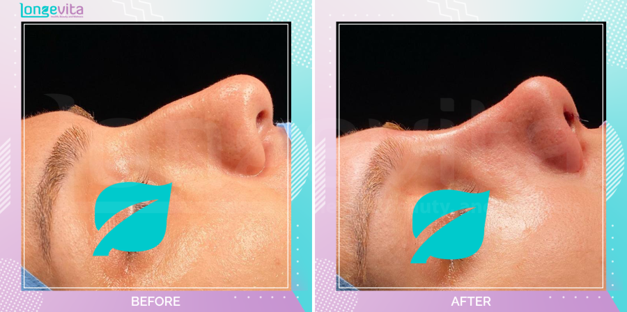 Rhinoplasty before and after, Face