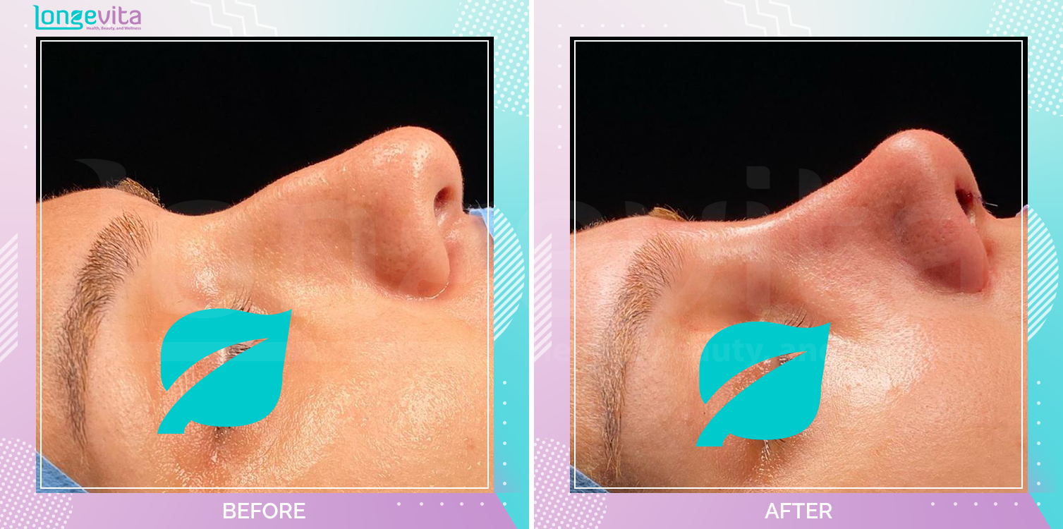 Rhinoplasty before and after, Face