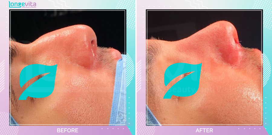 Rhinoplasty before and after, Face