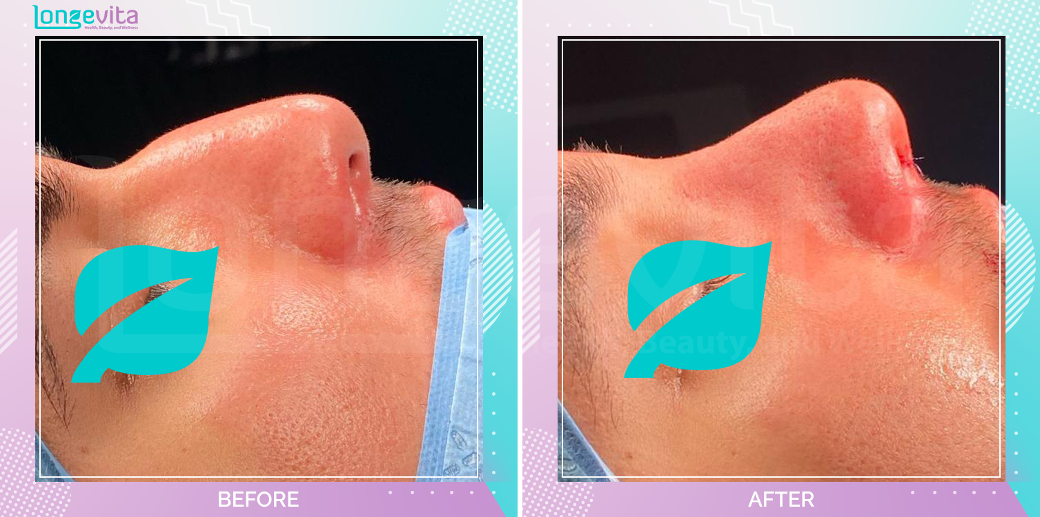 Rhinoplasty before and after, Face