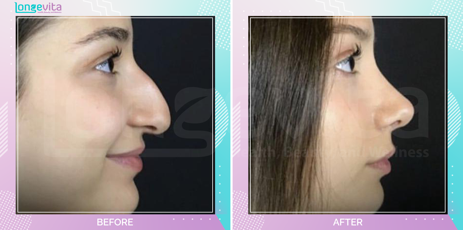 Rhinoplasty before and after, Face