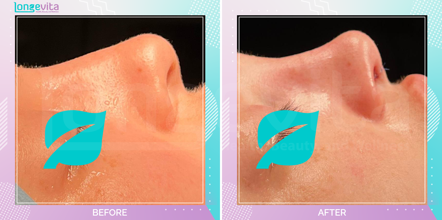 Rhinoplasty before and after, Face