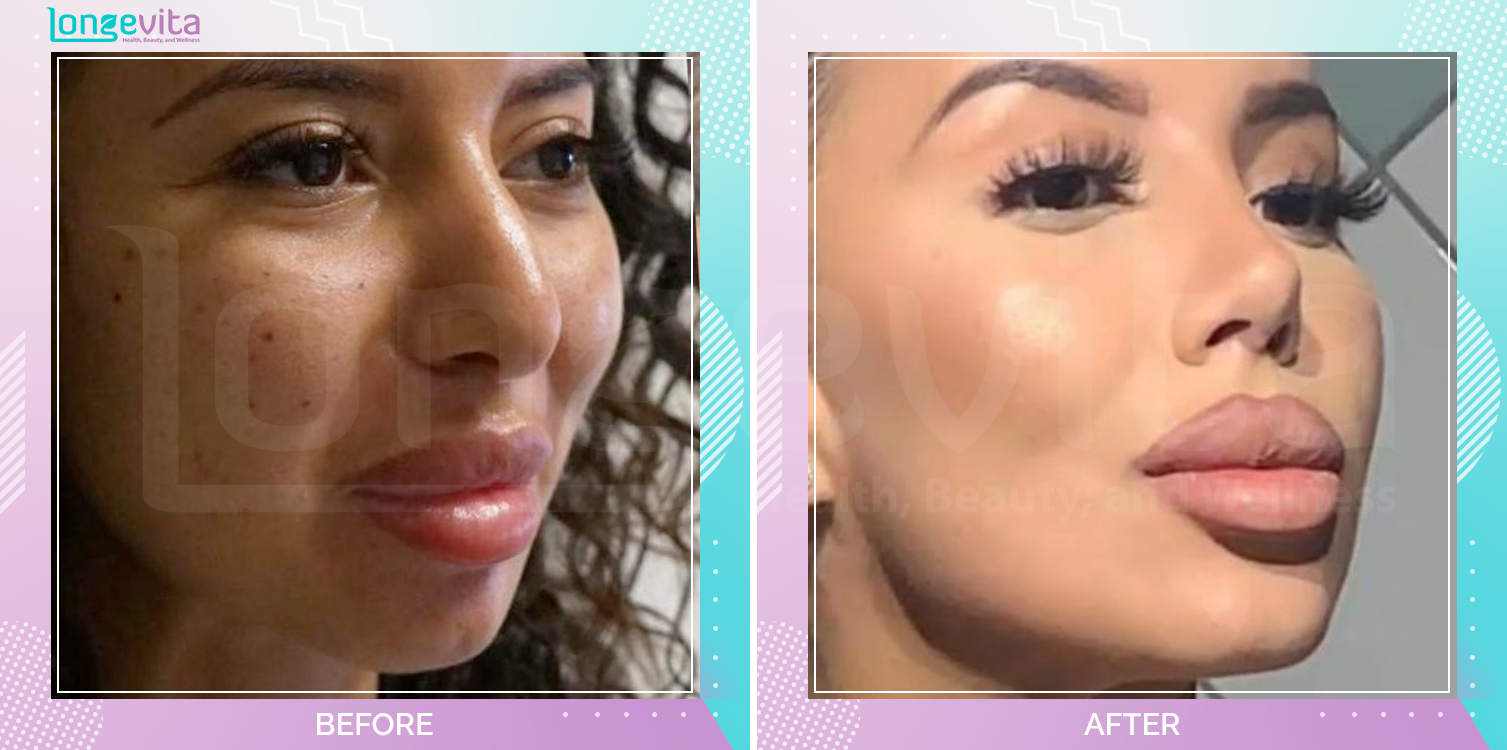 Rhinoplasty before and after, Face