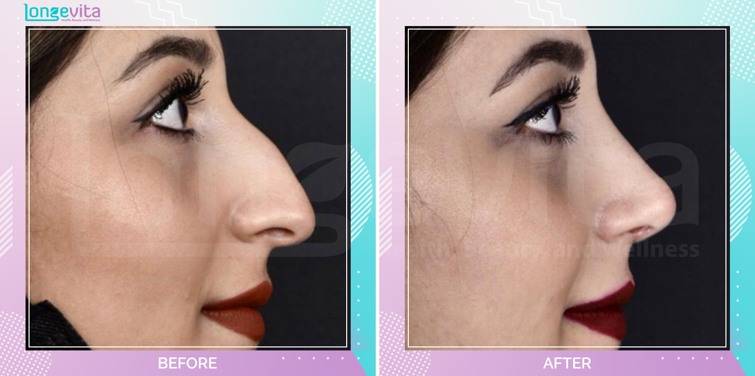 Rhinoplasty before and after, Face