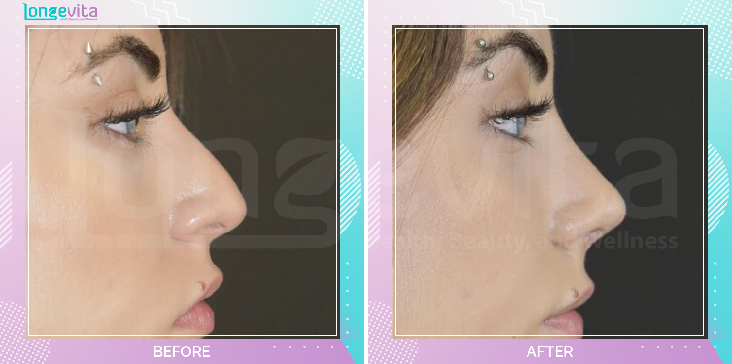Rhinoplasty before and after, Face