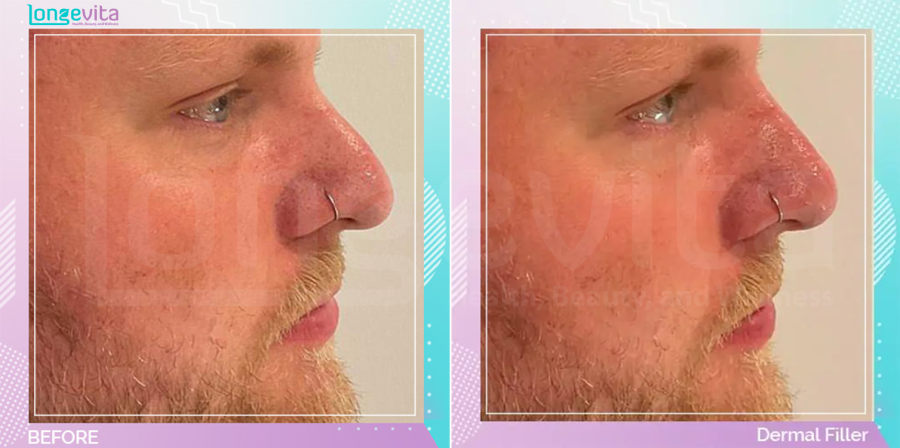 Dermal Fillers before and after, Face