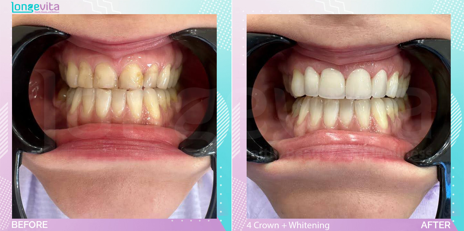 Crowns and Whitening before and after, 4 Porcelain Crown + Teeth Whitening units, 30s female patient