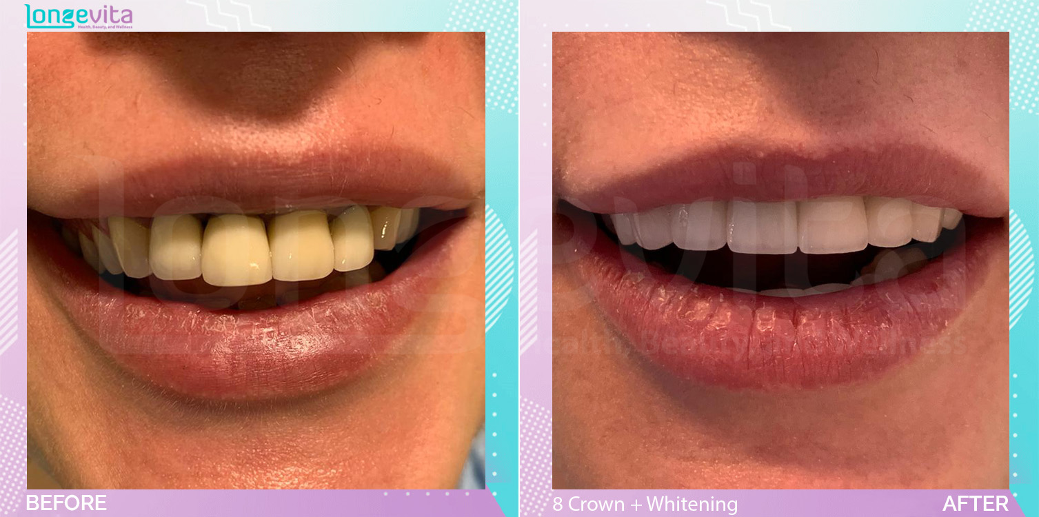Crowns and Whitening before and after, 8 Porcelain Crown + Teeth Whitening units, 40s female patient