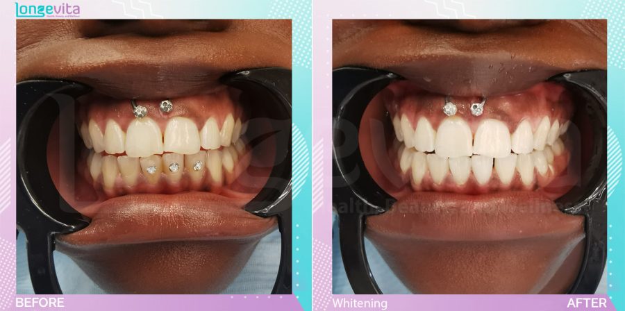Whitening before and after, Teeth Whitening units, 20s female patient