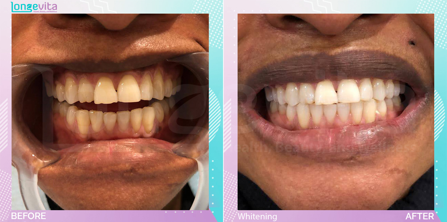 Whitening before and after, Teeth Whitening units, 30s female patient