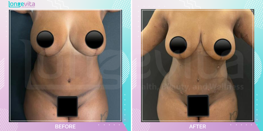 Liposuction and Tummy Tuck before and after, Body