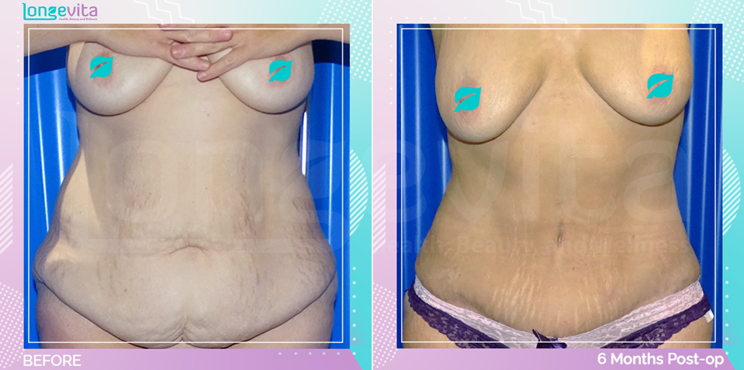 Tummy Tuck before and after, Body