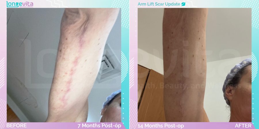 Arm Lift before and after, Body, 40s female patient