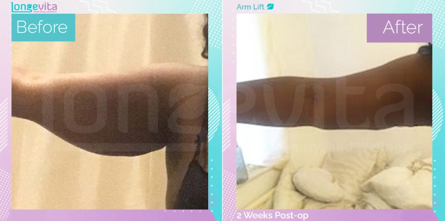 Arm Lift before and after, Body