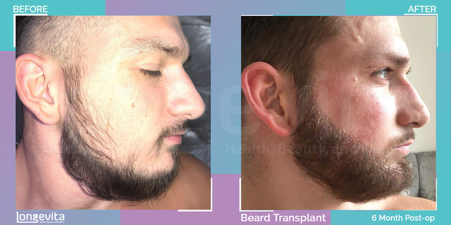 BEARD hair transplant before and after, 2500 grafts, 2 zones covered