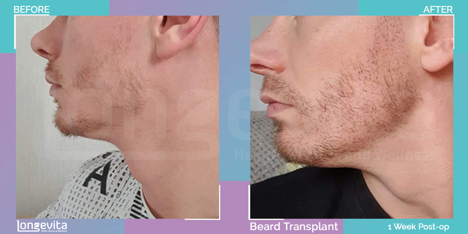 BEARD hair transplant before and after, 30s male patient