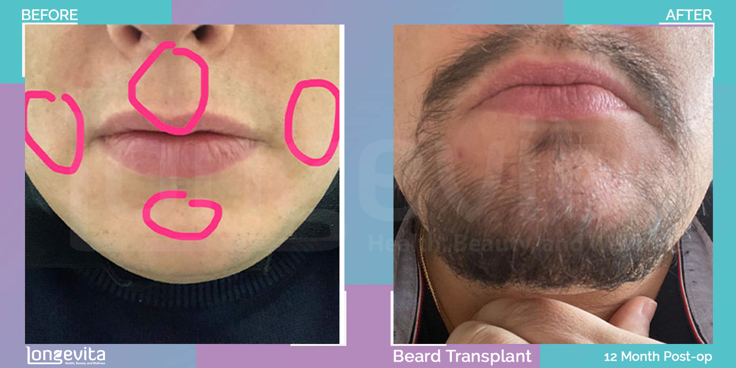 BEARD hair transplant before and after, 1000 grafts, 3 zones covered, 40s male patient