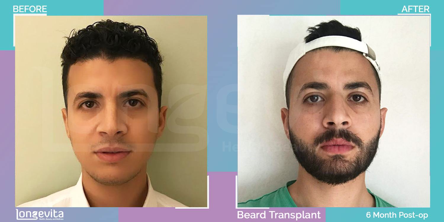 BEARD hair transplant before and after, 3500 grafts, 4 zones covered, 30s male patient
