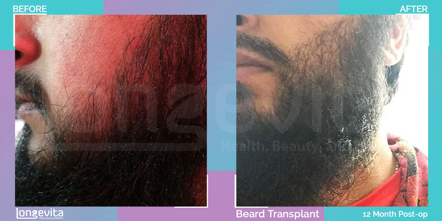 BEARD hair transplant before and after, 2500 grafts, 1 zone covered, 20s male patient