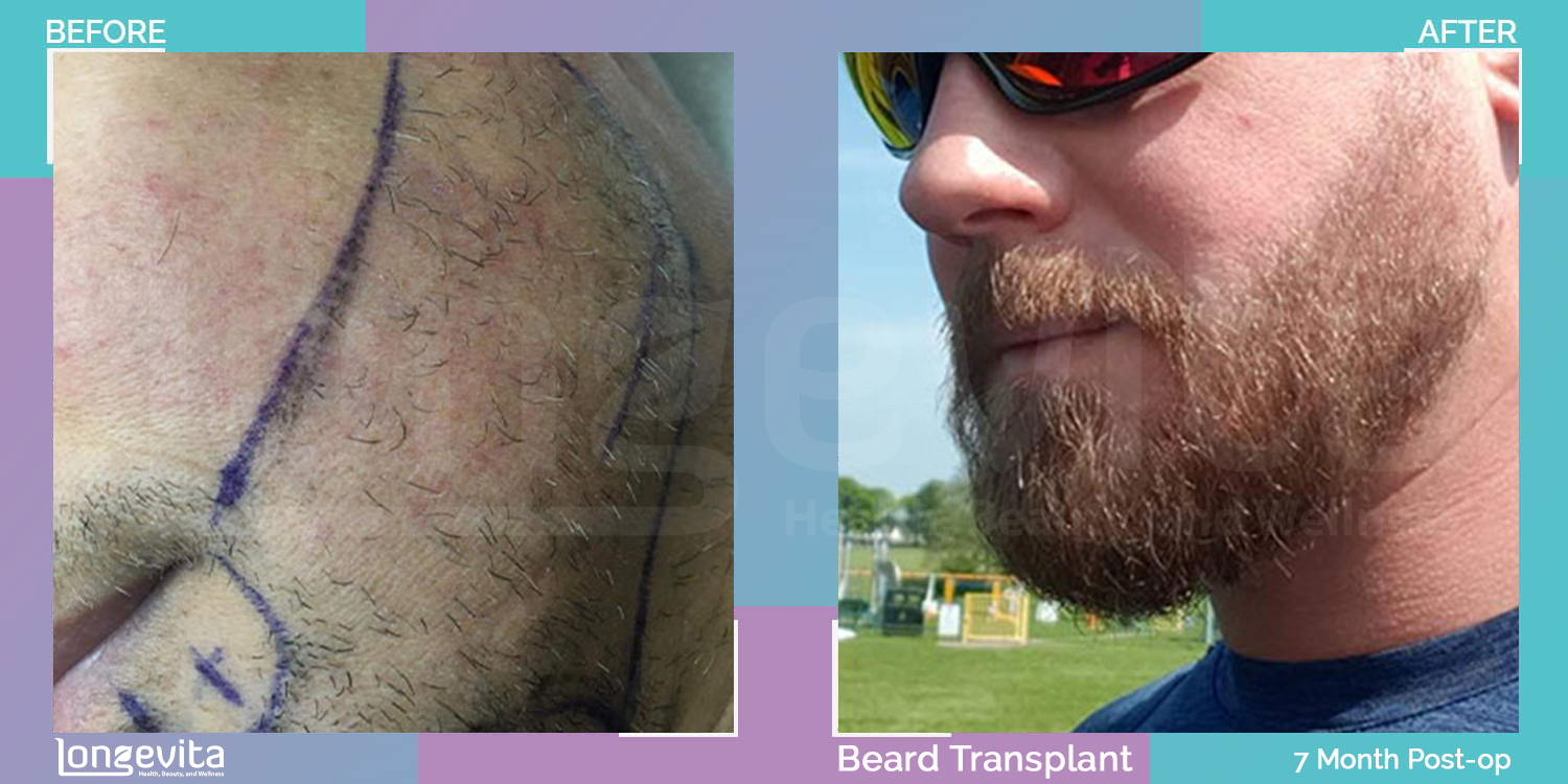 BEARD hair transplant before and after, 2600 grafts, 2 zones covered