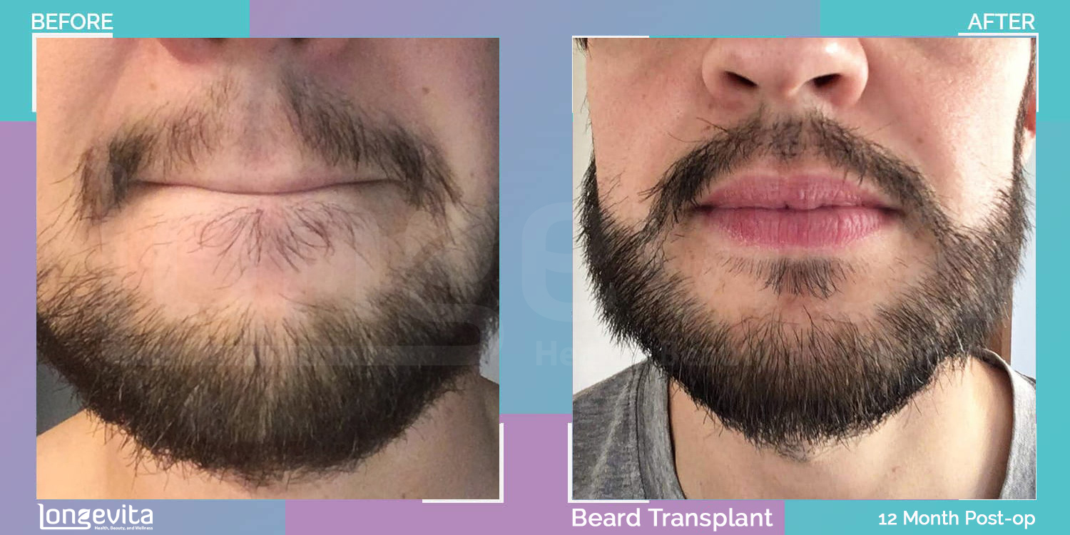 BEARD hair transplant before and after, 2800 grafts, 4 zones covered, 30s male patient