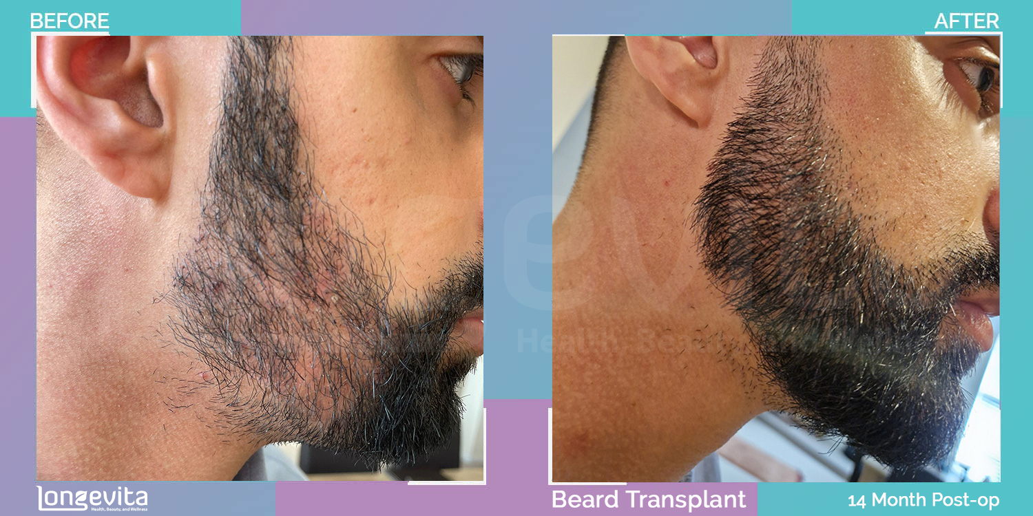 BEARD hair transplant before and after, 1250 grafts, 2 zones covered, 30s male patient