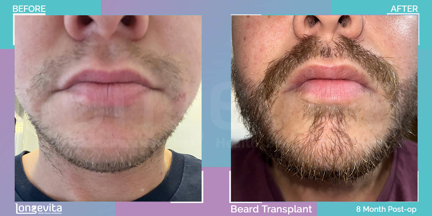 BEARD hair transplant before and after, 2500 grafts, 4 zones covered, 30s male patient