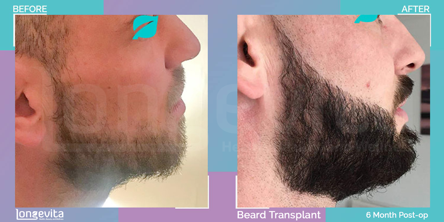 BEARD hair transplant before and after, 3500 grafts, 4 zones covered