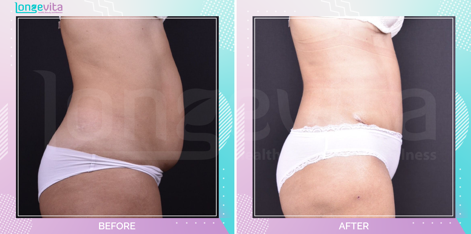 Liposuction and Tummy Tuck before and after, Body