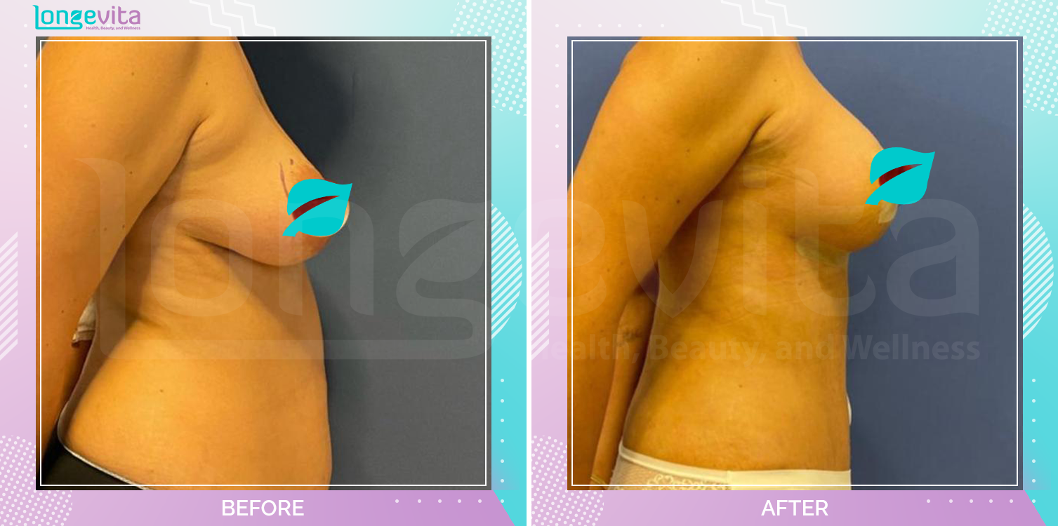 Breast Enlargement and Breast Lift and Liposuction and Tummy Tuck before and after, Body