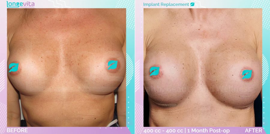 Implant Replacement before and after, Breast, 40s female patient