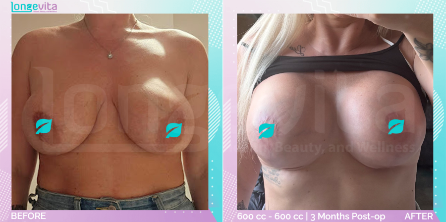 Breast Lift and Implant Replacement before and after, Breast, 30s female patient