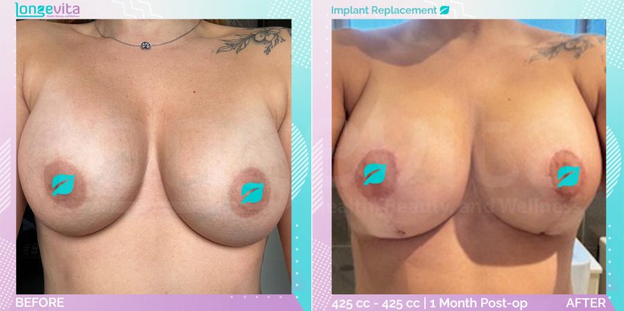 Breast Lift and Implant Replacement before and after, Breast, 30s female patient