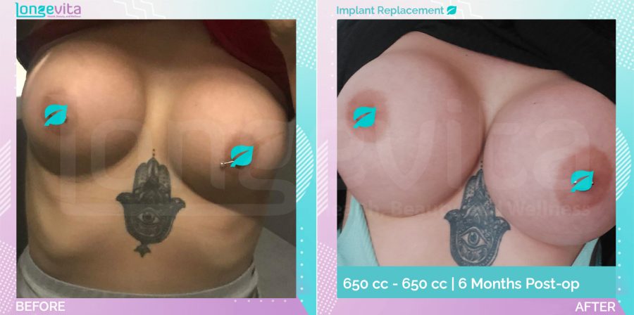 Breast Lift and Implant Replacement before and after, Breast, 20s female patient