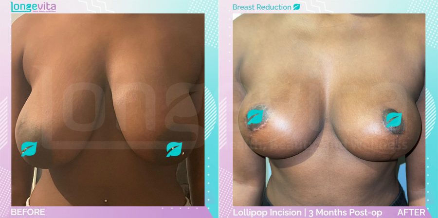 Breast Reduction before and after, Breast, 20s female patient