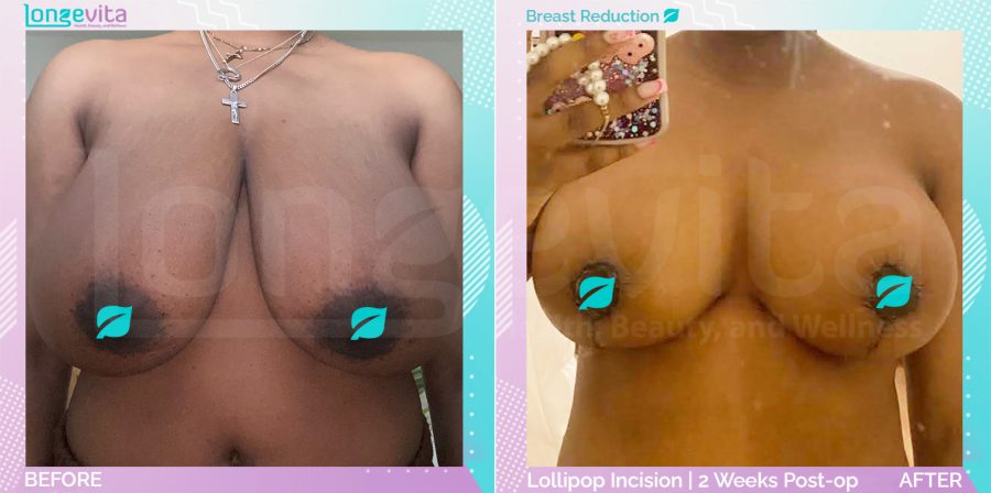 Breast Reduction before and after, Breast, 20s female patient
