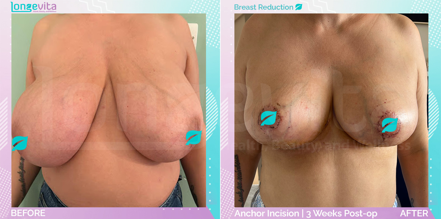 Breast Reduction before and after, Breast, 30s female patient