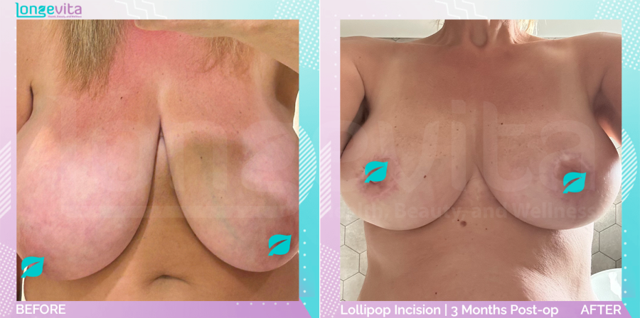 Breast Reduction before and after, Breast, 50s female patient