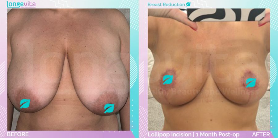 Breast Reduction before and after, Breast, 30s female patient
