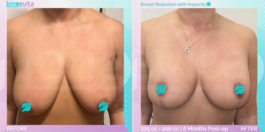 Breast Implant and Breast Reduction before and after, Breast, 40s female patient
